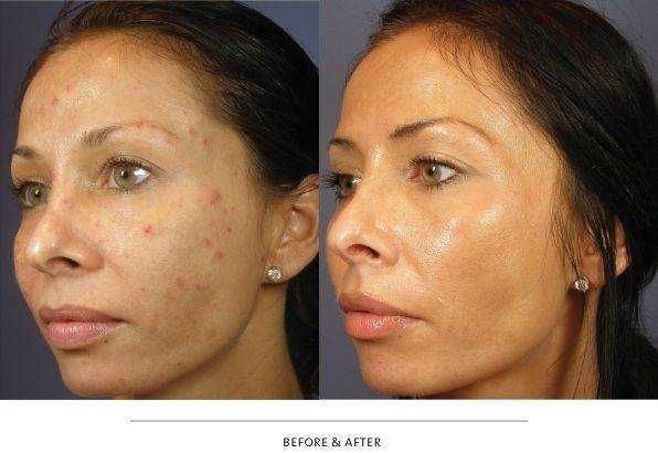 Laser Viora Medical, Radiofrequência bipolar e Fraccionada