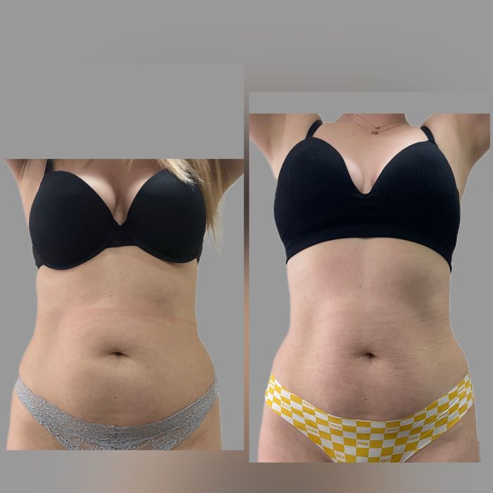 Кріоліполіз, кавітація, обгортання, ролик