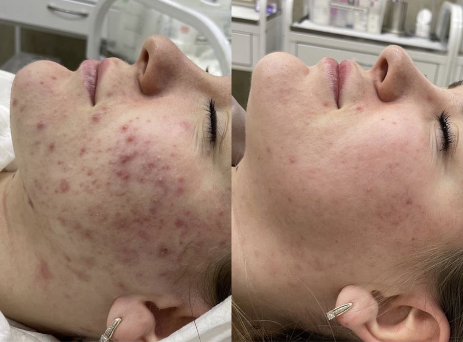 Лечение акне, врач дерматолог , врач косметолог.