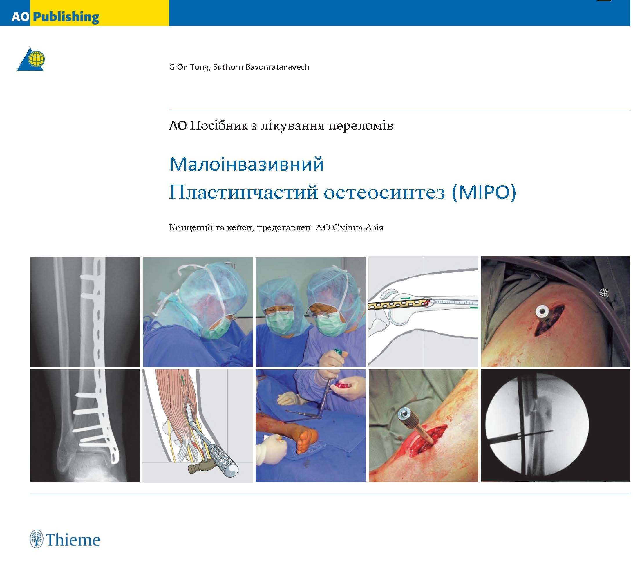 AO TRAUMA  Малоінвазивний пластинчатий остесинтез.