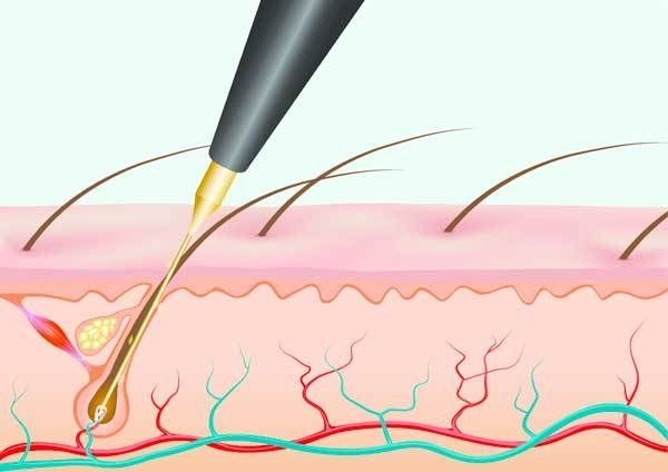 Електроепіляція навчання