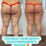 Лімфодренажний масаж. Вібраційний масаж. Косметолог