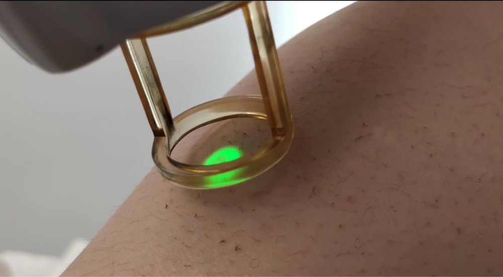 Maquina depilacao laser yag/alexandrit