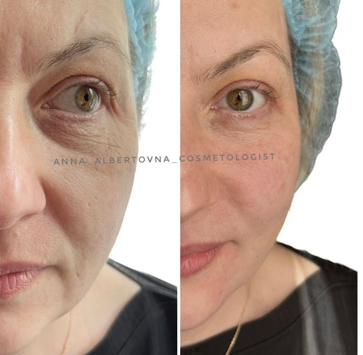 Косметолог/Ботокс Акция 1700 две зоны/Левый берег/