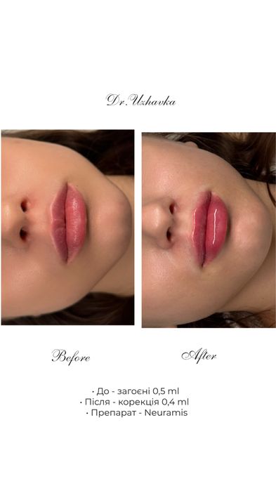 Модель на контурна пластика Губ/збільшення губ|Ботокс|Косметолог Одеса