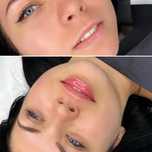 Powiększanie/modelowanie ust oraz BOTOX.
