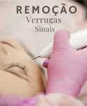 Remova verrugas e sinais sem cortes, sem cirurgia e com recuperação rá