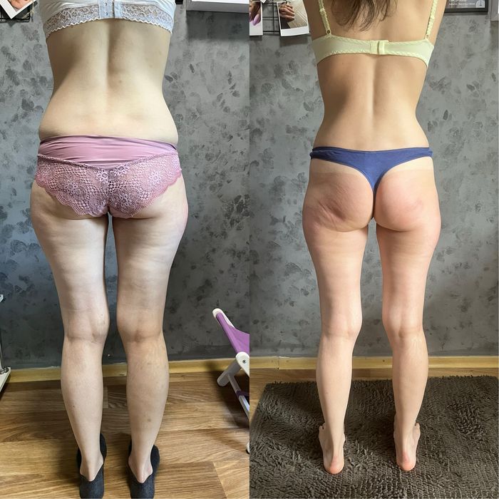 Пресотерапія, ліпопластика, лімфодренаж, кавітація  , масаж