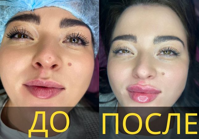 Чистка лица ботокс косметолог пилинг лазерная эпиляция увеличение губ