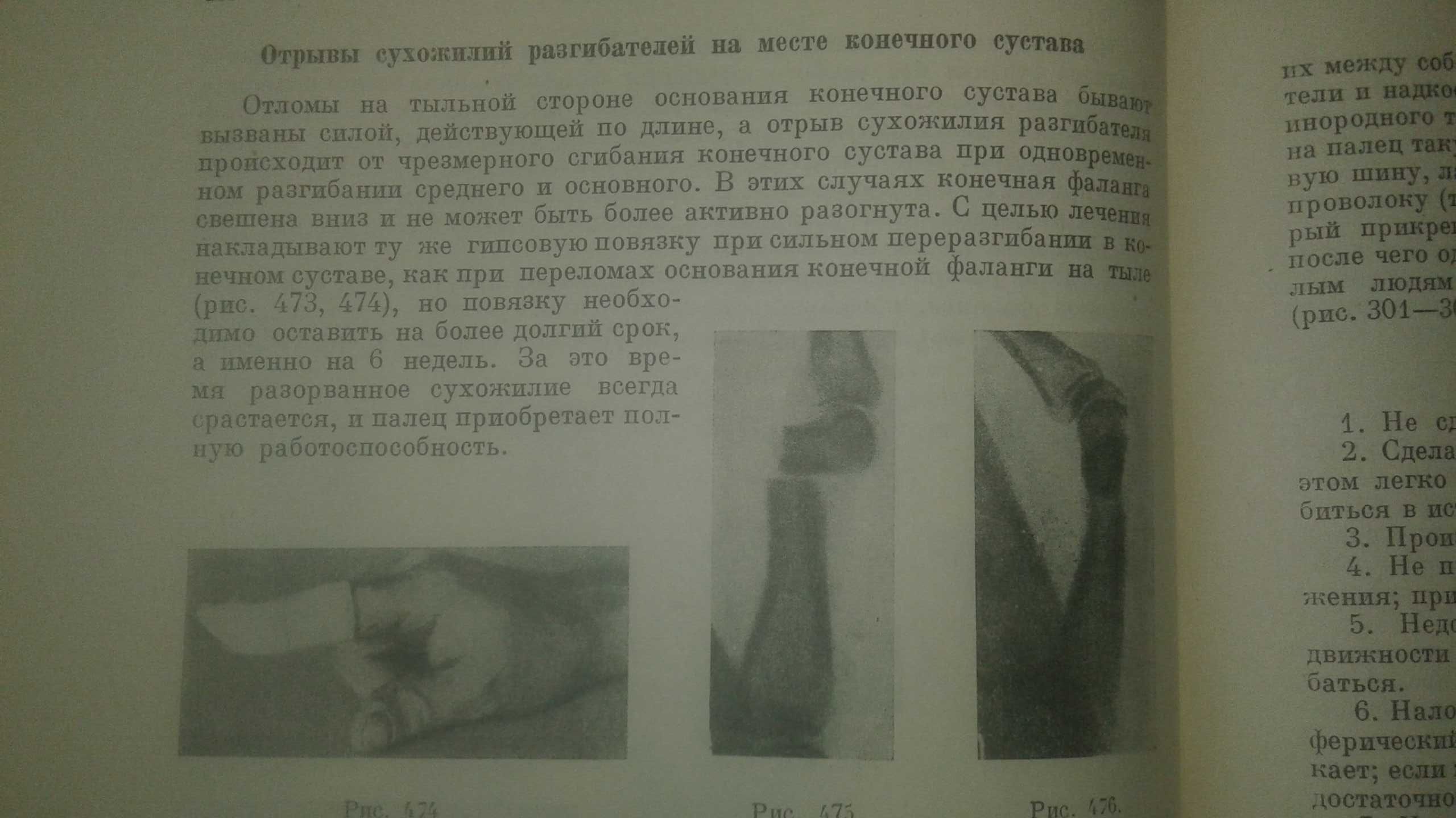 Лечение переломов костей 1937 год Леон Белер антикварная книга