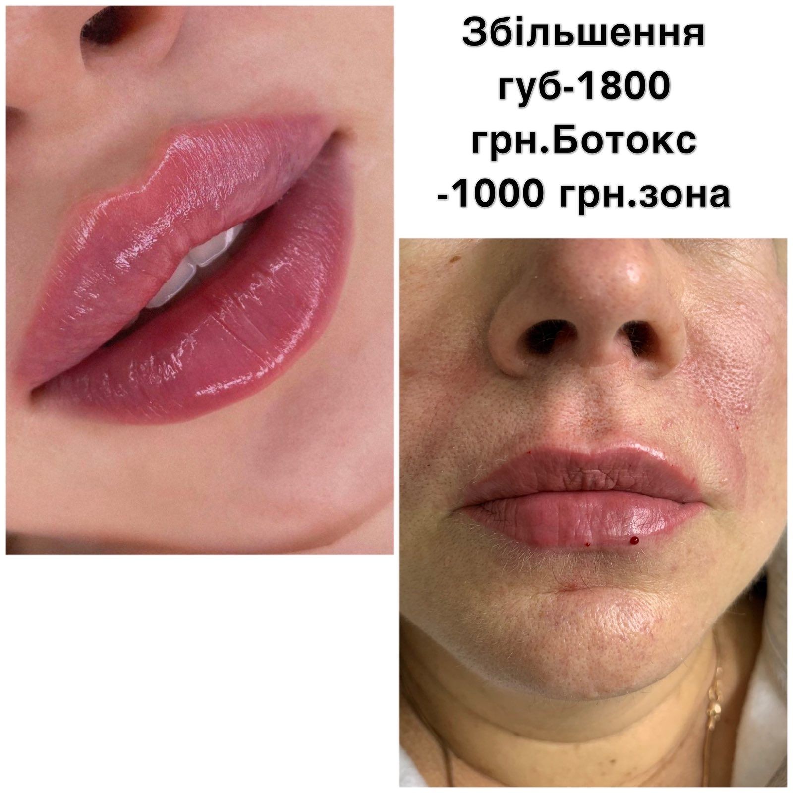 Збільшення губ - ін'єкційна косметологія в Борисполі