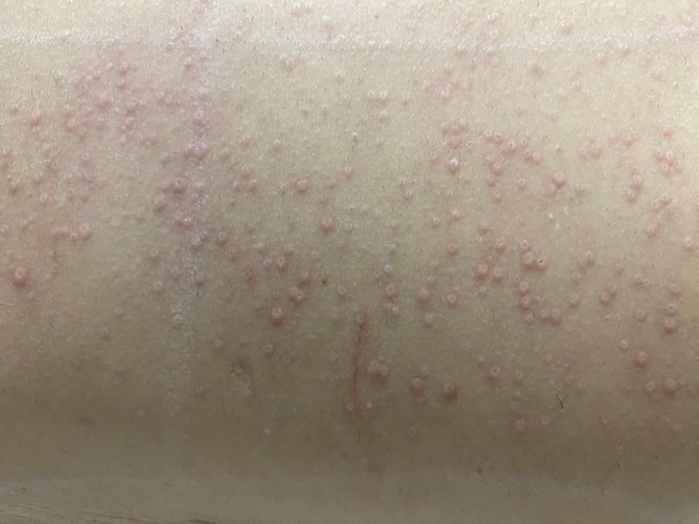 Serviço de depilação a laser