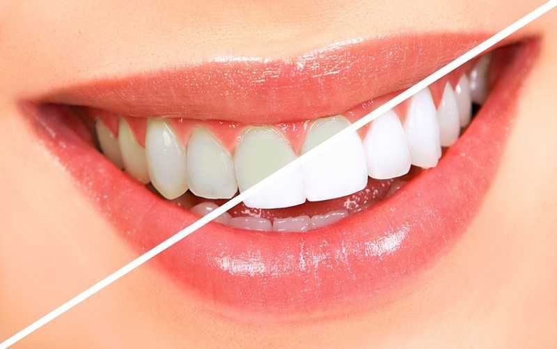 Блиск Вашої посмішки через відбілення зубів