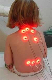 Máquina de Laser Kolina 5a Geração para Acupuntura, Fisioterapia