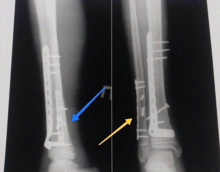 Титанова пластина(Медична)