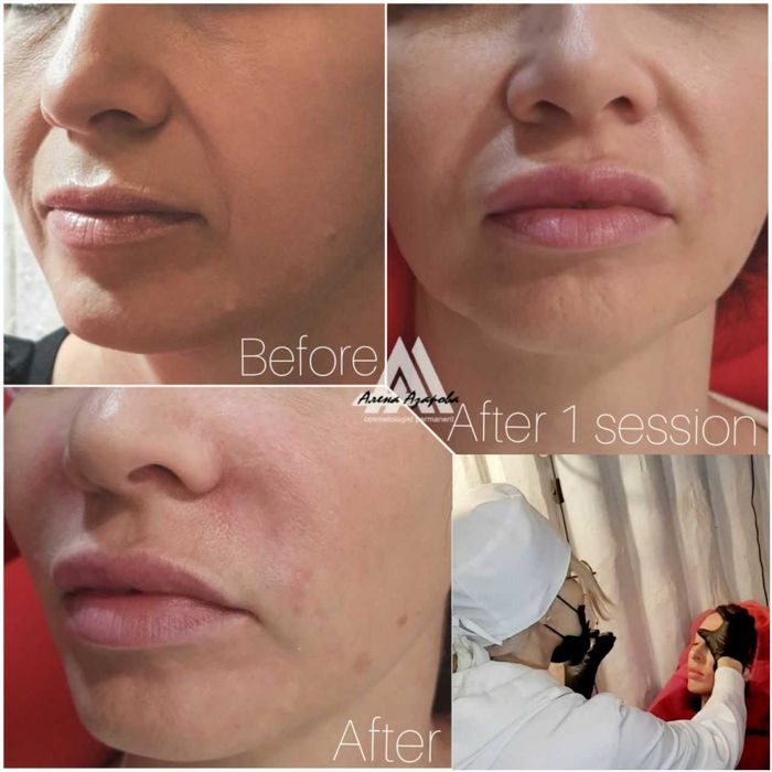 Косметолог. Контурная пластика, увеличение губ. Работаю р-н Госпрома.