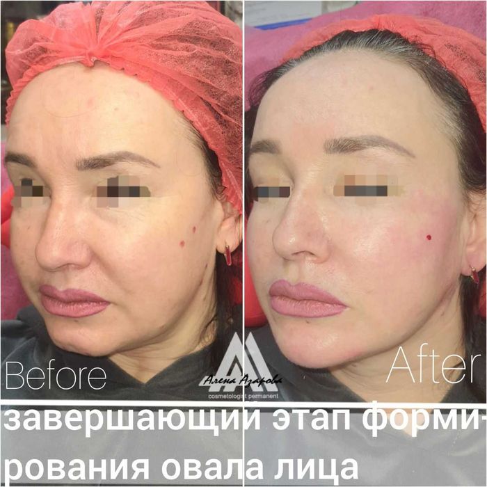 Косметолог. Контурная пластика, увеличение губ. Работаю р-н Госпрома.