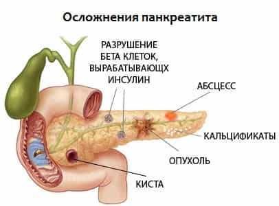 Панкреасан хр.панкреатит