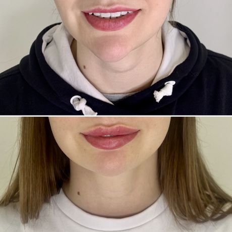Модели на увеличение губ