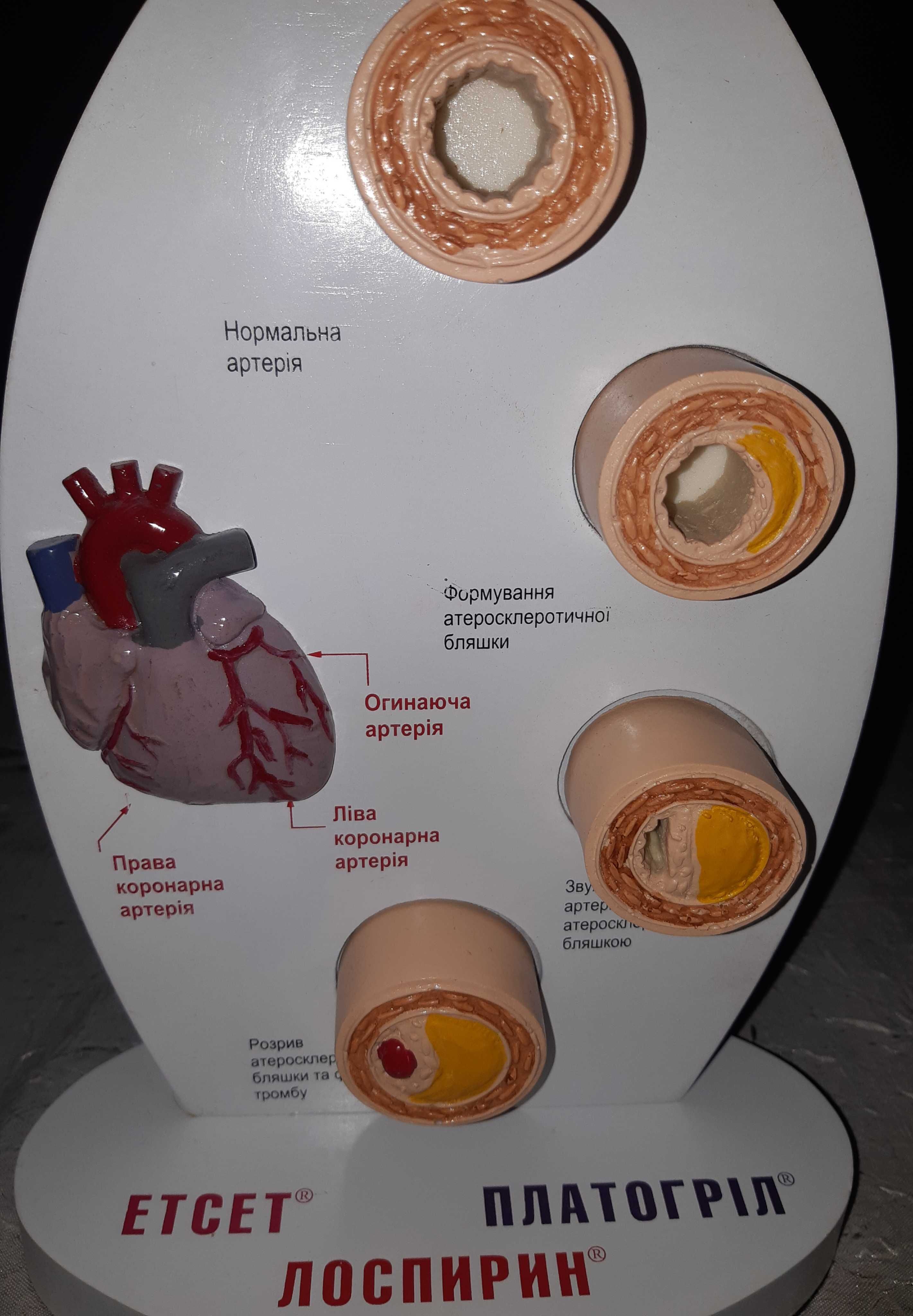 Продам "Модель атеросклероза"