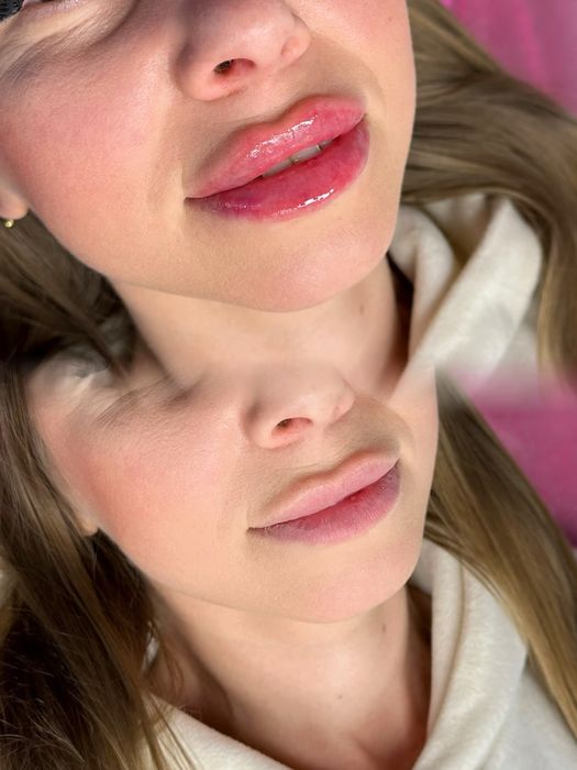 Акція. Контурна пластика губ. Запоріжжя