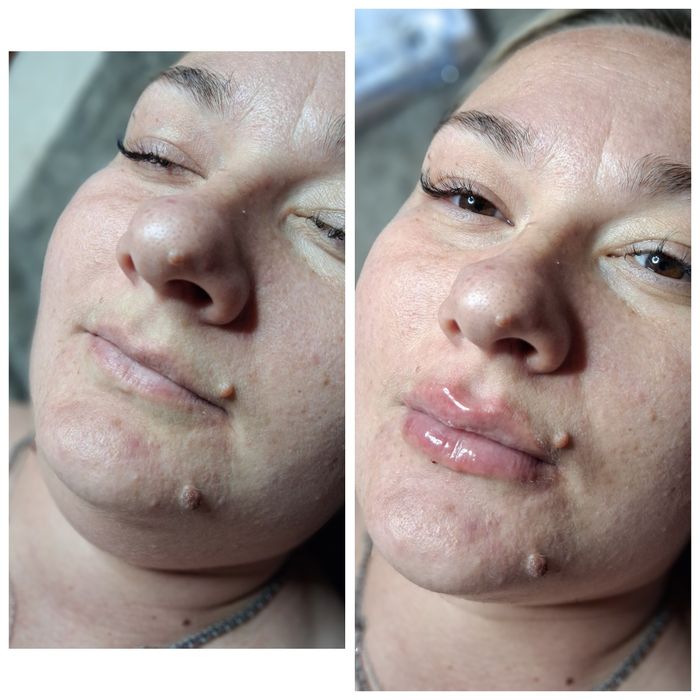 Косметолог Кривой Рог(губы, ботокс,чистка лица)