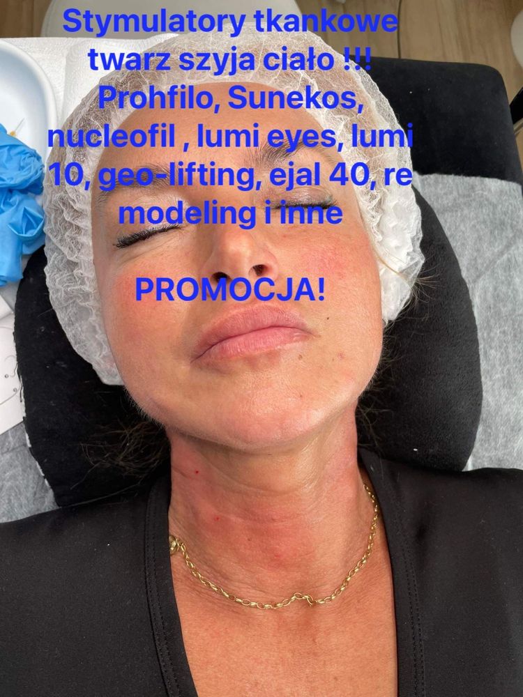 Powiększanie ust,stymulatory tkankowe,botox,Rzesy,lipoliza,dermapen,op