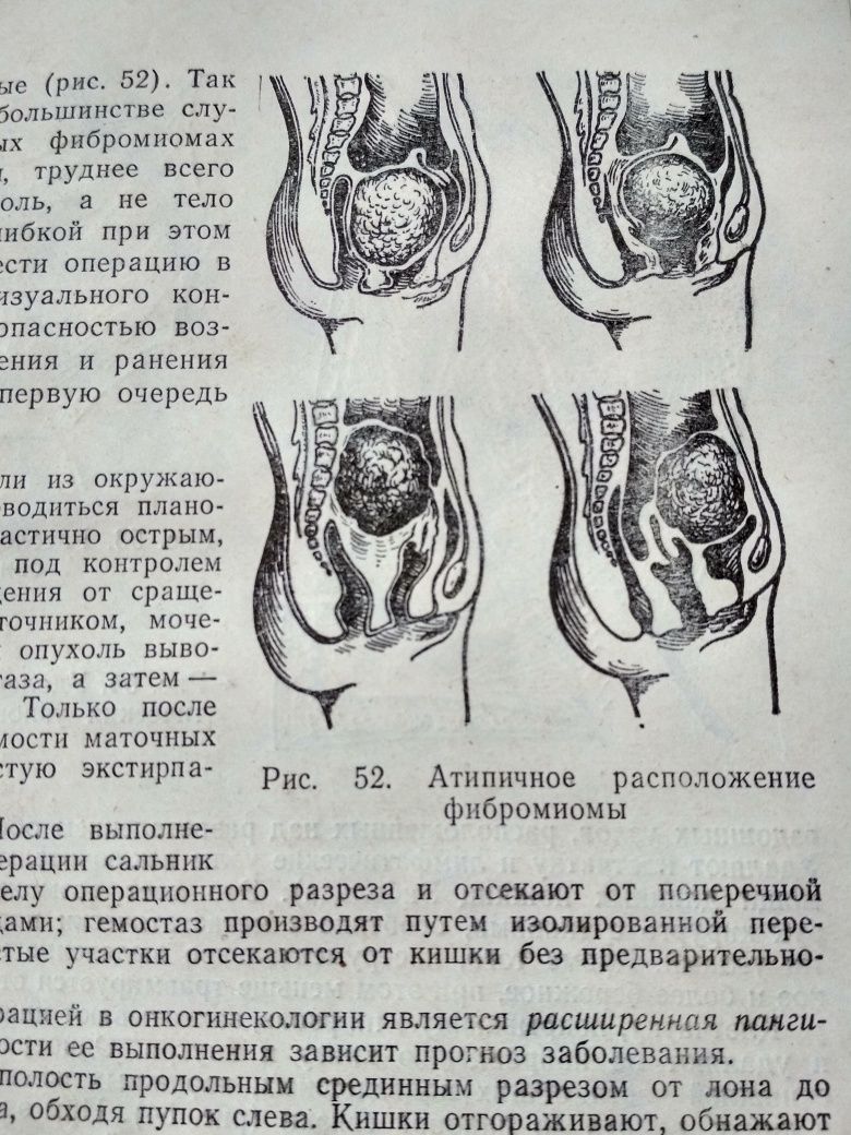 Онкологическая гинекология под редакцией Винницкой В.К.