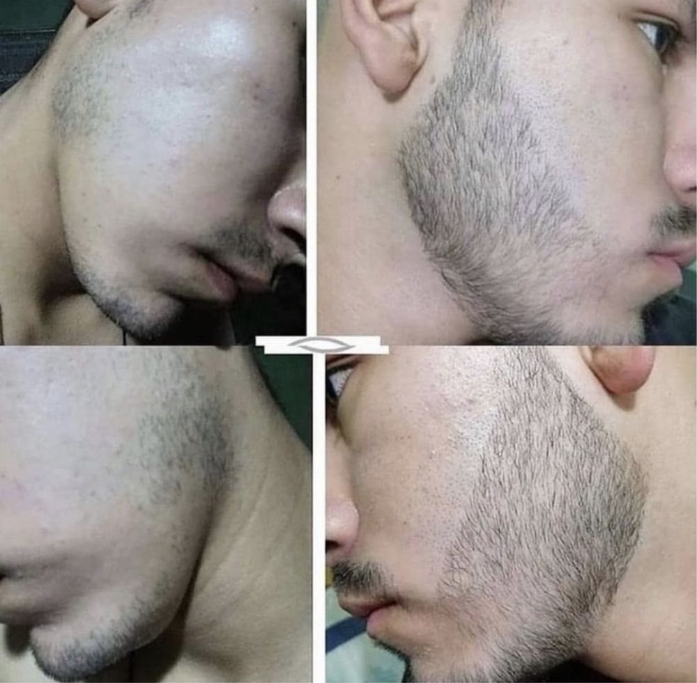 Minoxidil 2 frascos +dermaroller