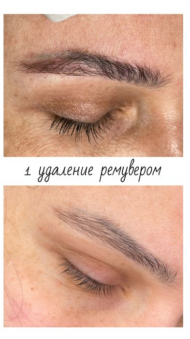 Видалення тату і перманентного макіяжу будь якої складності від 500грн