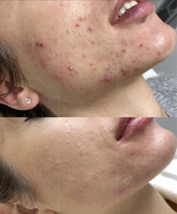 Лечение акне, врач дерматолог , врач косметолог.