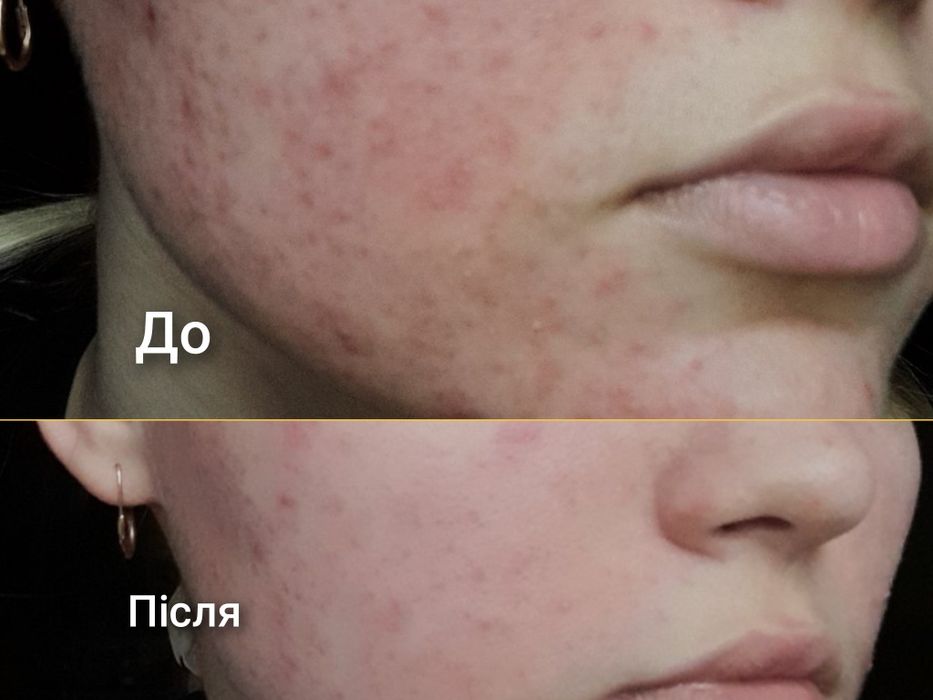 Косметолог з медичною освітою. Апаратний антицелюлітний масаж.