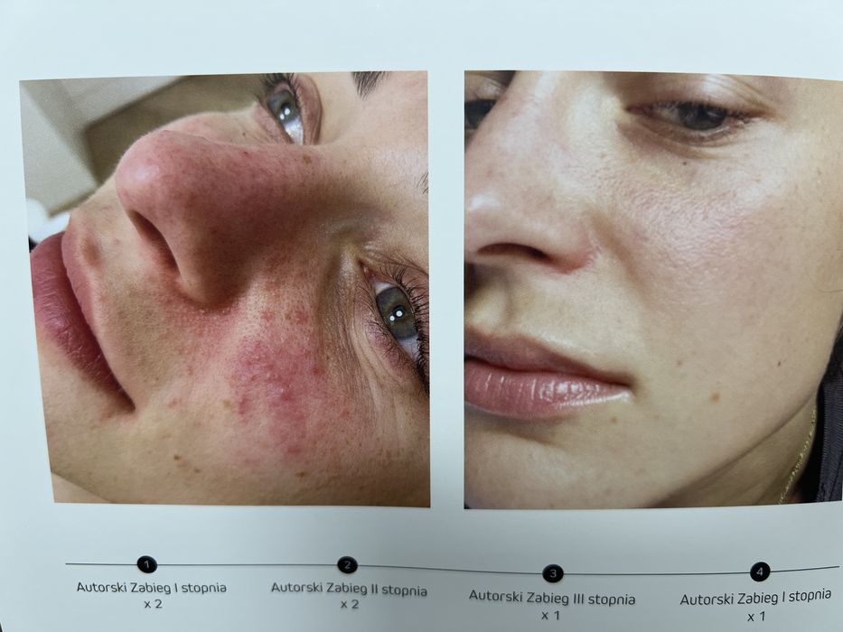 Pro XN Antioxidant Therapy LIGHT Serum wersja gabinetowa