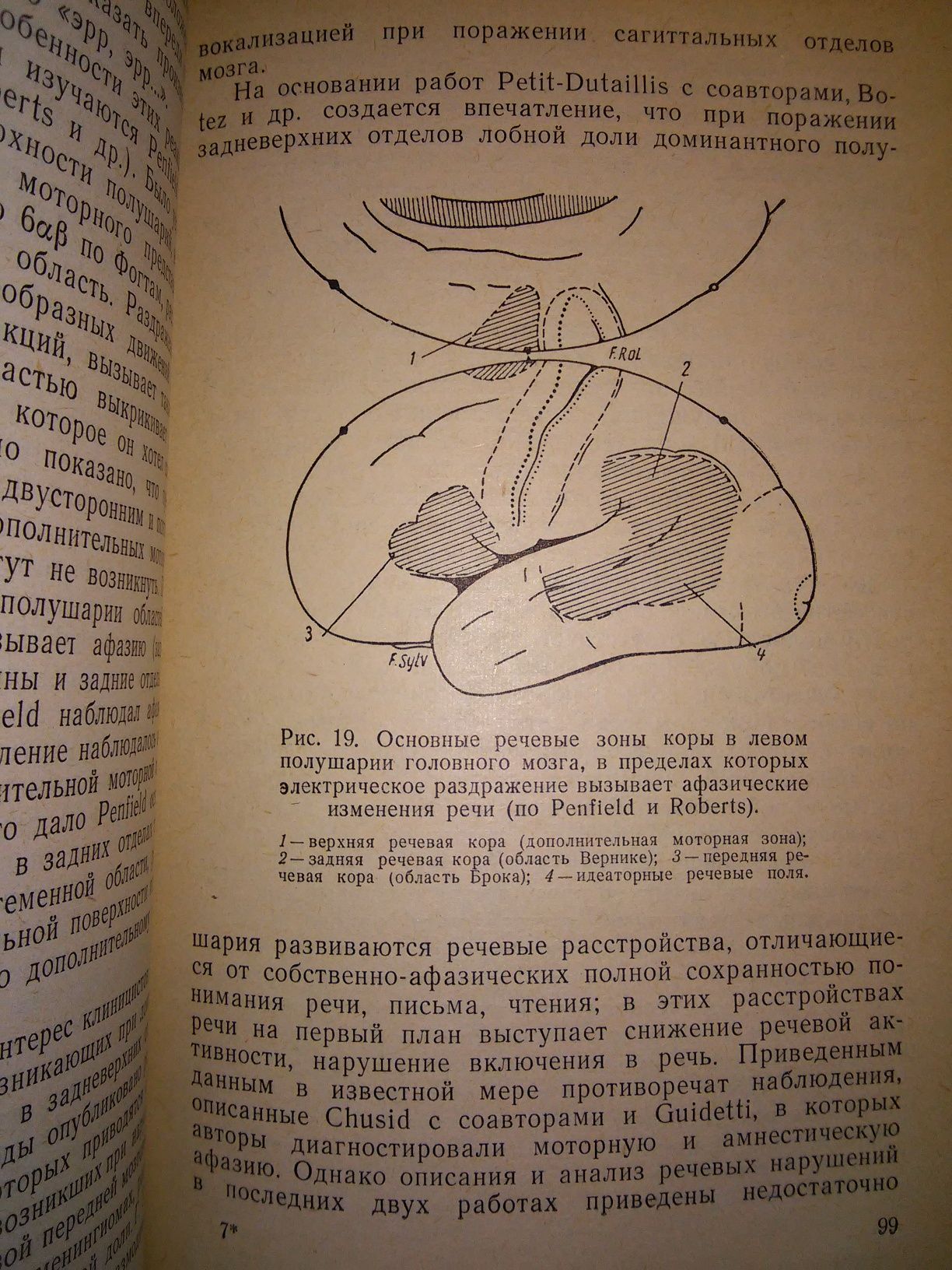 Тонконогий Инсульт и афазия 1968