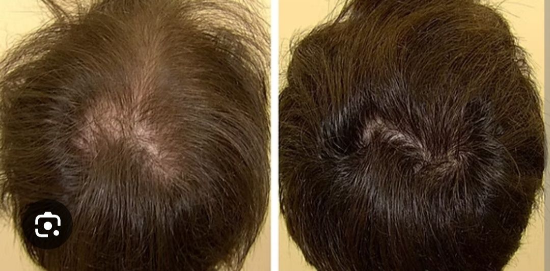 Frasco Minoxidil 90 ml