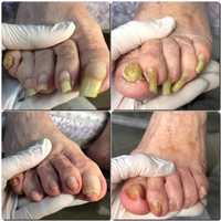 pedicure, obcinanie paznokci dla osób starszych