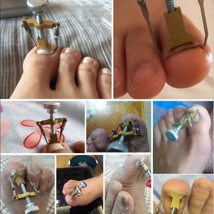 Corretor de unhas encravadas NOVO