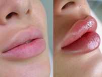 Usta/botox/mezoterapia