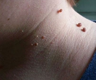 Косметолог-уход-массаж, удаление папиллом, бородавок, пигментных пятен