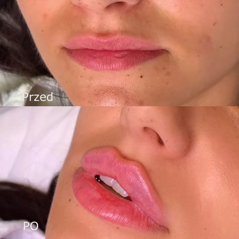 Powiększanie ust na płasko 1ml350zł,2ml450zł,botox,niciPDO4D,lipoliza,