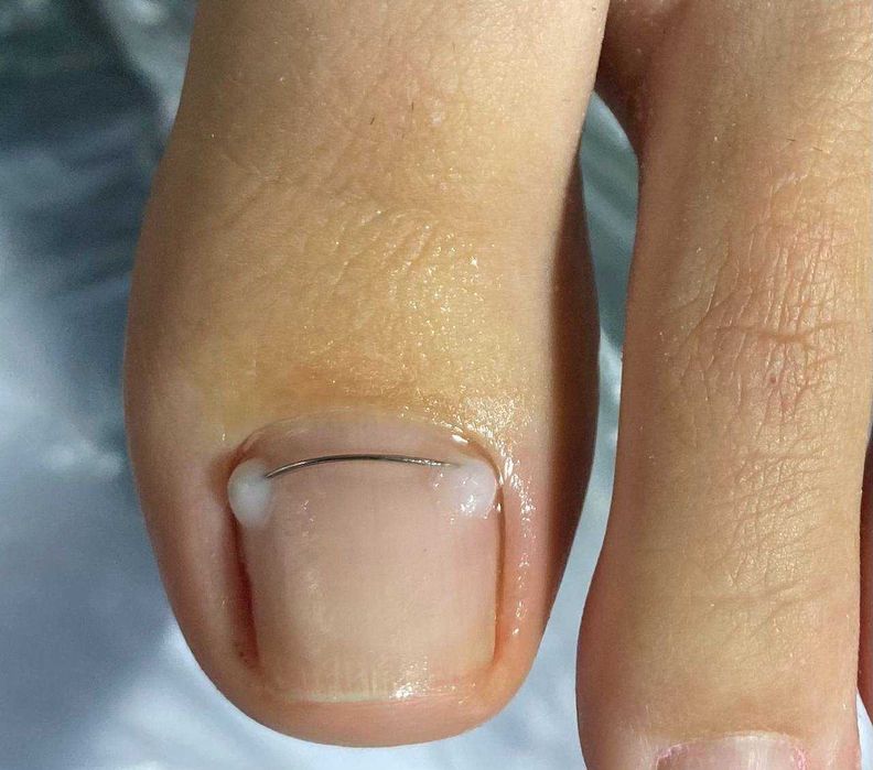 Подолог с Выездом на Дом для стариков,вросший ноготь,грибок,Медпедикюр