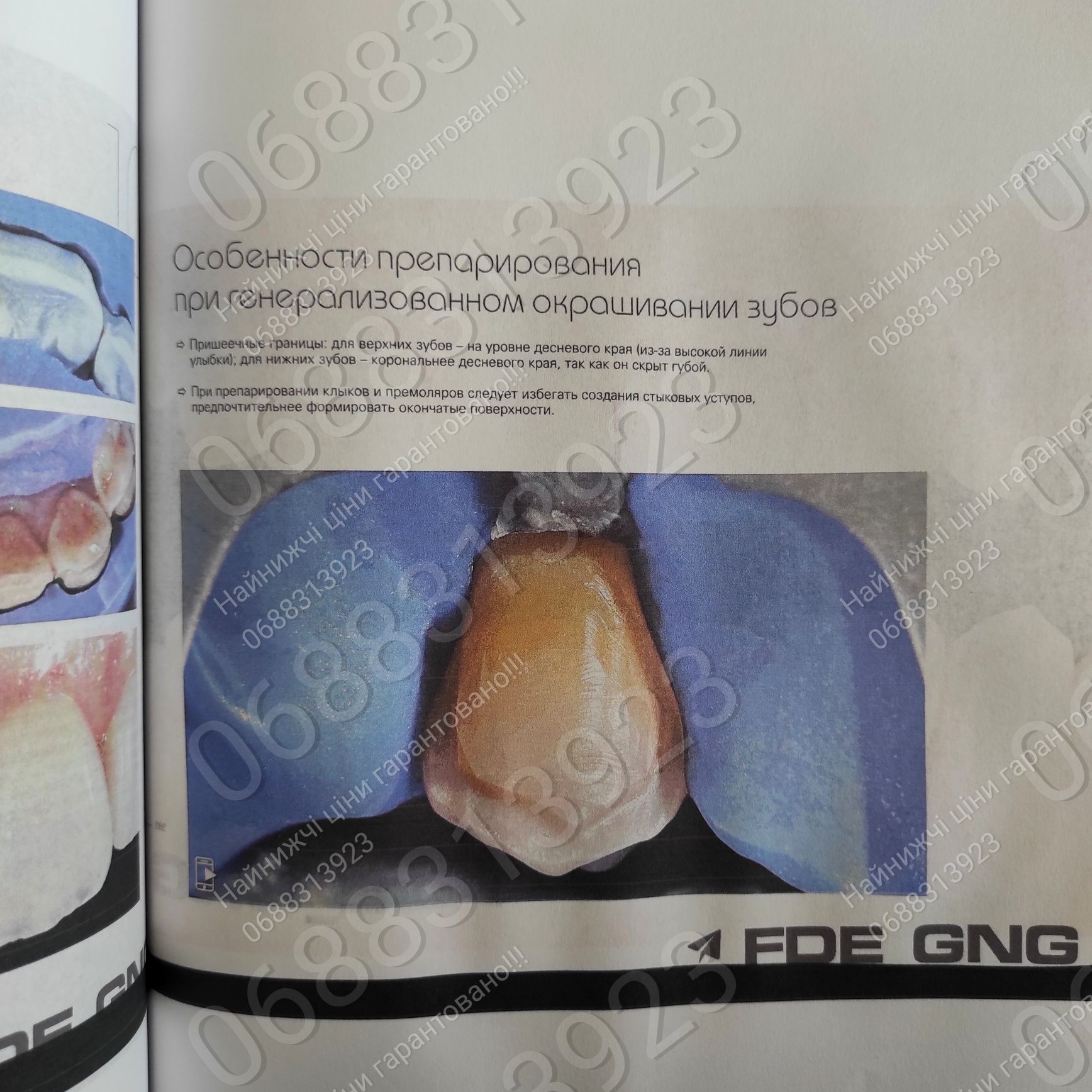 NEW!!! Керамические винири, Стефан Куби, стоматологія, книги