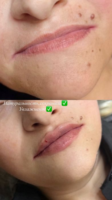 Ботокс.Увеличение губ.Гипергидроз