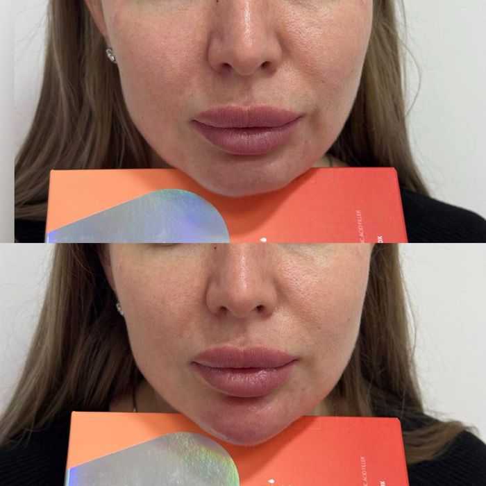 Збільшення губ,ботокс,мезотерапія,біоревіталізація,чистка обличчя