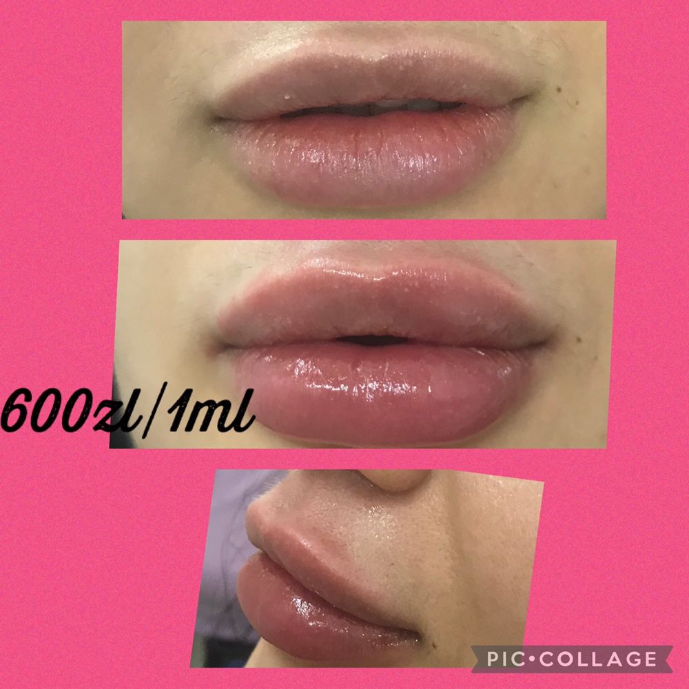 PROMOCJA botox powiększanie ust hialuronowy laser HIFU