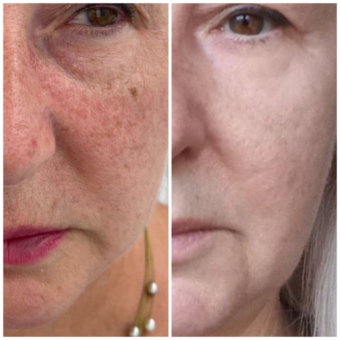 Холодна плазма НОВА розробка вчених Косметологічний апарат