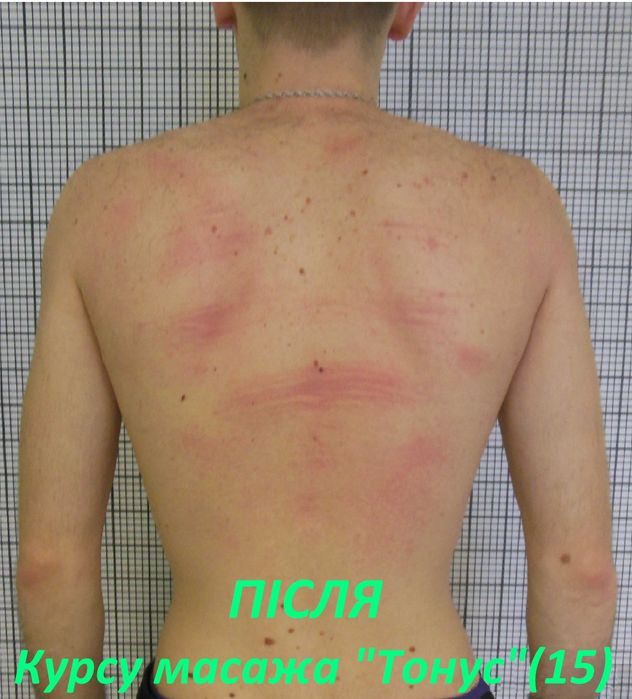 Гарантоване лікування сколіозу у дітей і дорослих