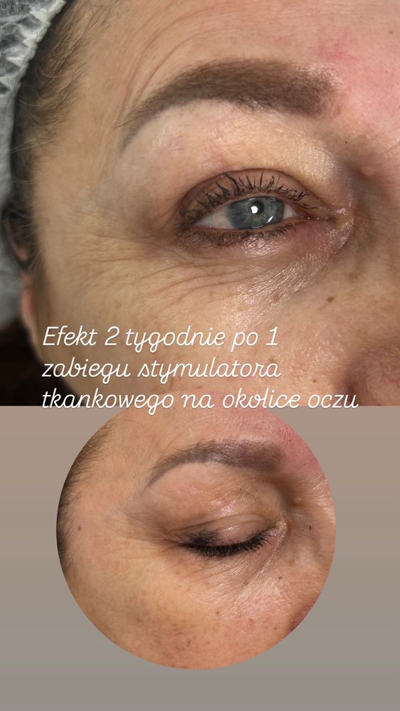 Powiększanie ust, botox , wolumetria, endermologia WARSZAWA 250 zł