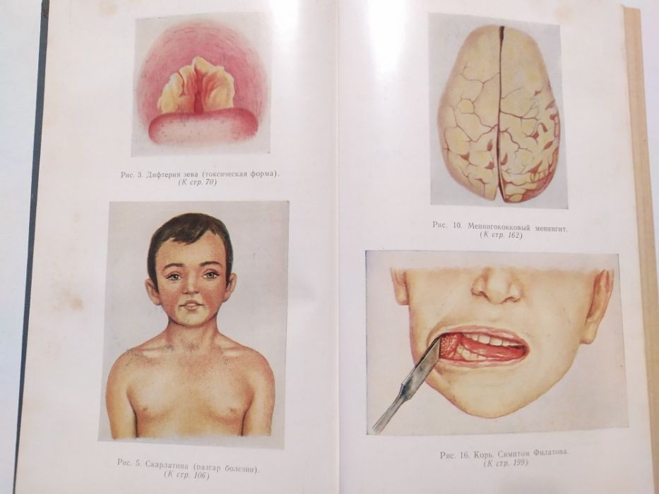 Детские инфекционные болезни А.Т.Кузьмичева,И.В.Шарлай 1984г.