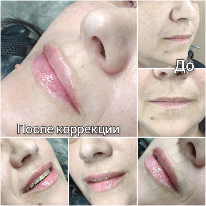 Контурна пластика губ!  2500грн.Потрібні моделі!